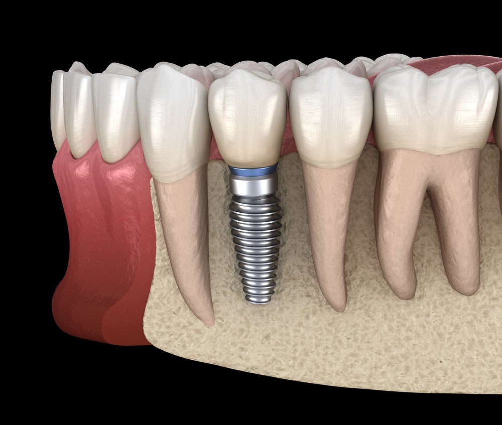 Premolar tooth recovery with implant. Medically accurate 3D illustration of human teeth and dentures concept